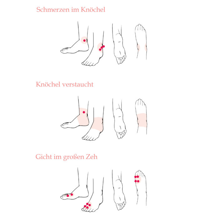 Qi-Magnet-Akupunktur – Bild 3